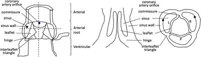 Development of the Human Arterial Valves: Understanding Bicuspid Aortic Valve